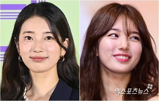 Suzy Undergoes Cosmetic Procedure to Remove Long-Standing Issue